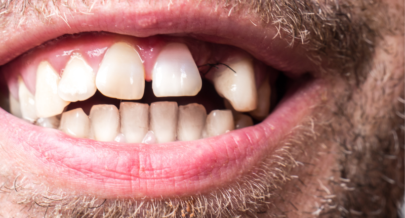 gaps in teeth