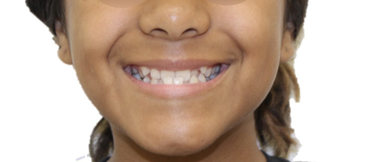 before treatment by orthodontist